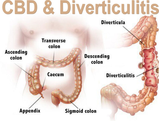 CBD & Diverticulitis