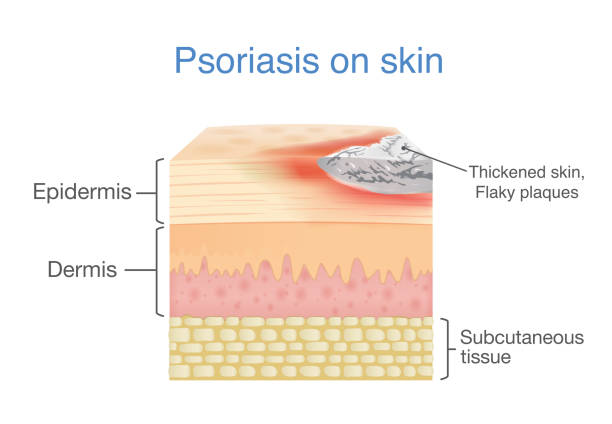 Psoriasis:  How CBD could be the relief you are looking for