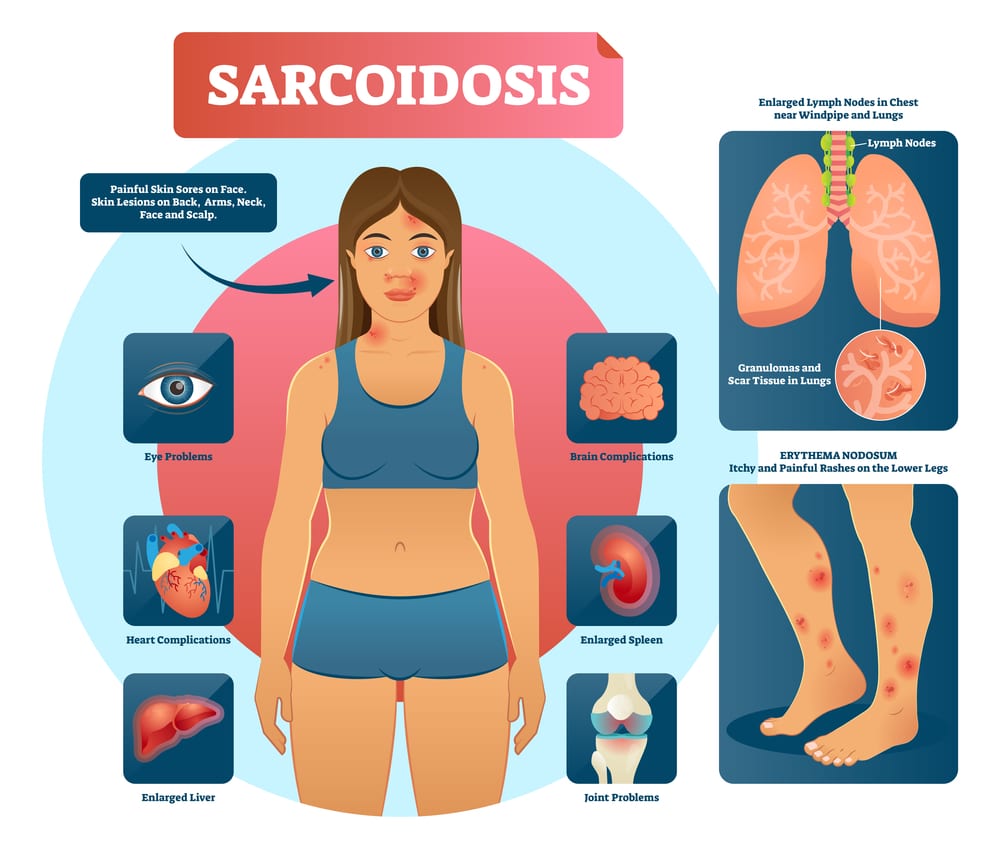 Sarcodosis:  Add CBD to your fight