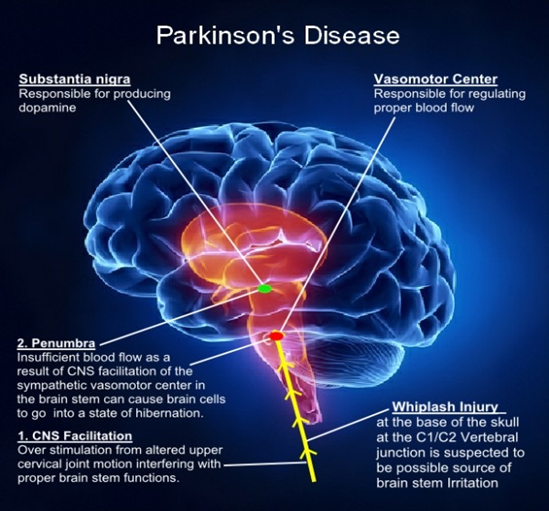 CBD & Parkinson's Disease